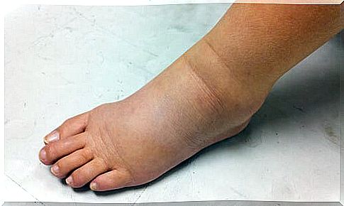 Edema or swelling