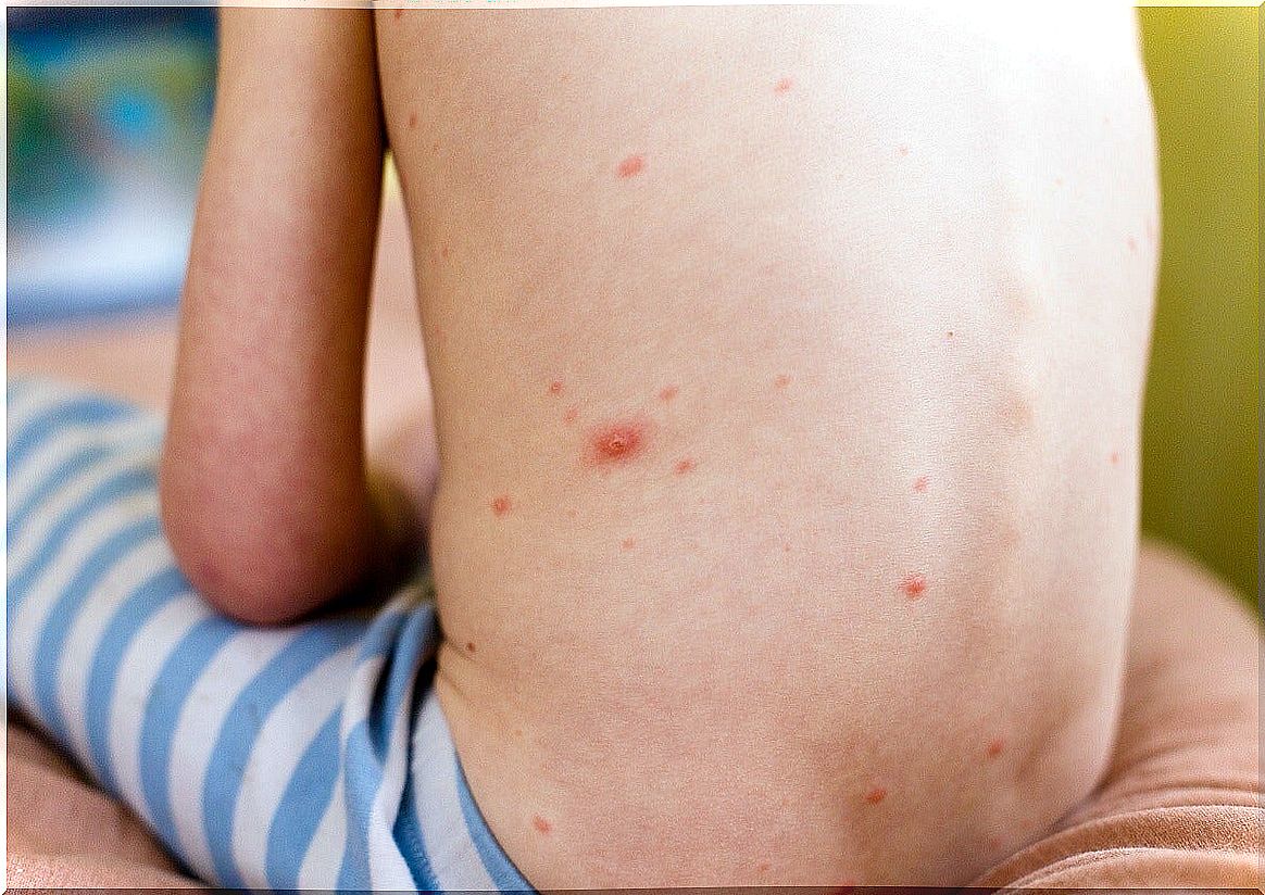 Urticaria on the back of children.