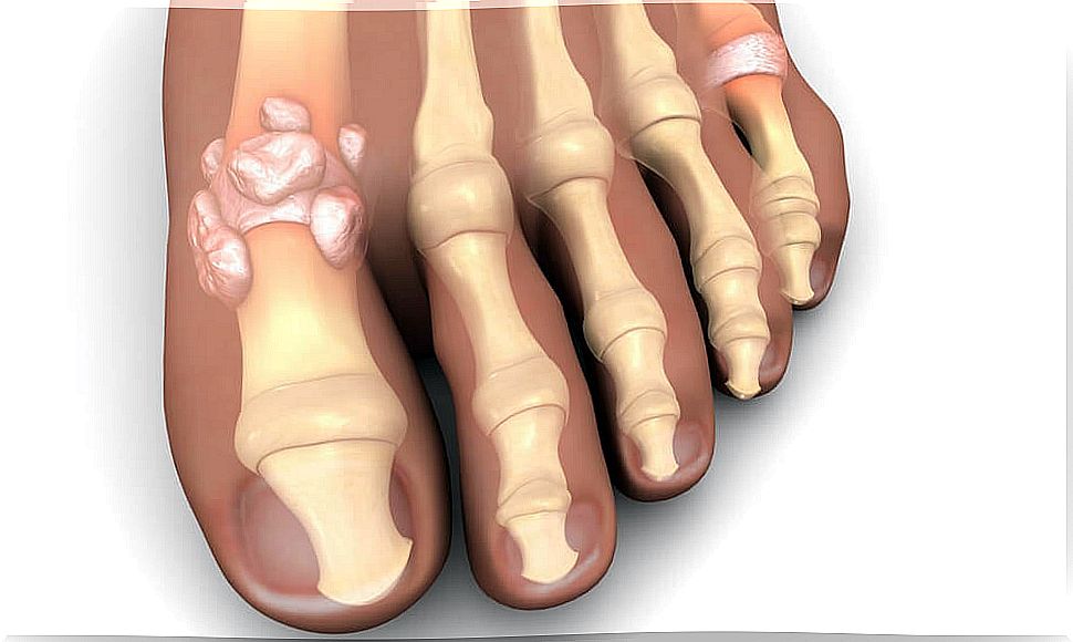 Gout disease.