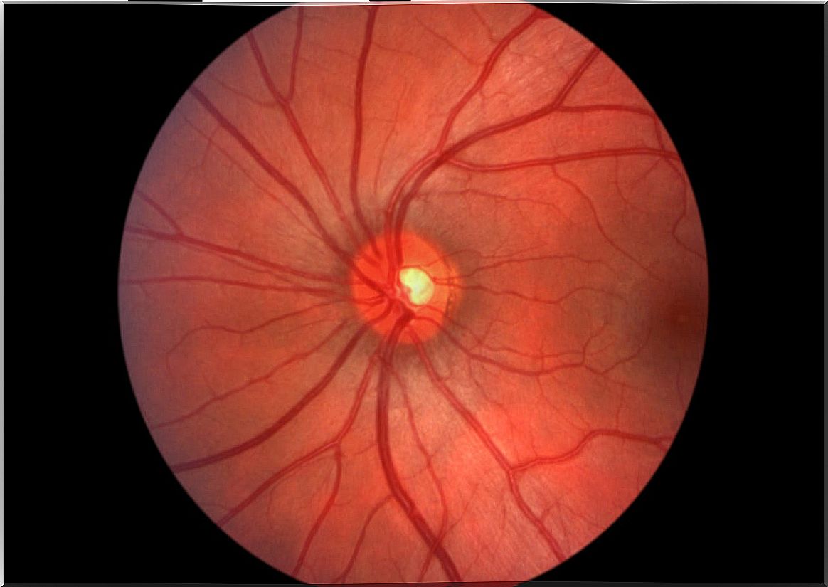 Fundus to detect drusen.