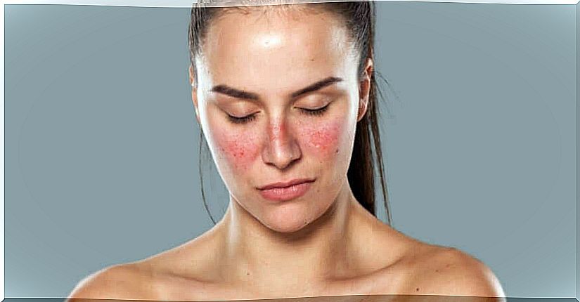 Woman with lupus