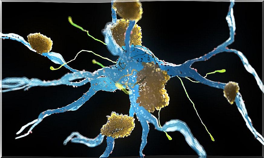 Neurons with Alzheimer's.