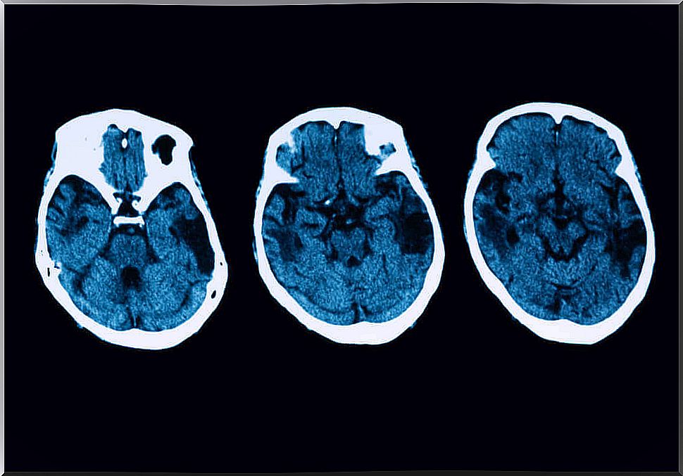 Posterior cortical atrophy: diagnosis and treatment