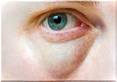 Swollen eyelids: causes and treatments