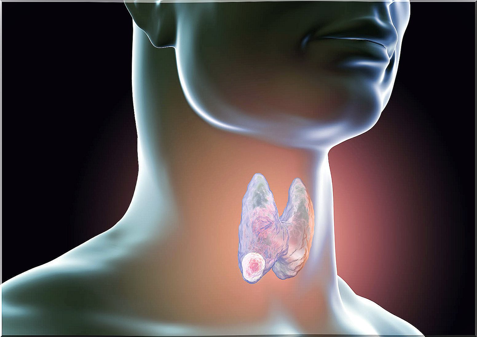 Symptoms in women that warn of possible thyroid cancer