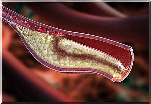 High cholesterol in children