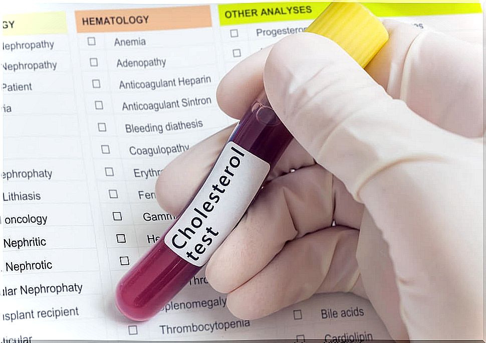 Doctor holding a tube of blood with the inscription "cholesterol test"